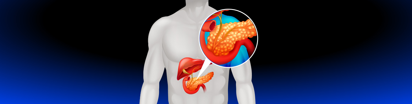 All you need to know about pancreatitis